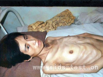 艾滋病人体重下降明显