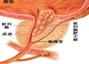 前列腺炎有什么症状能治好吗？前列腺炎要重视