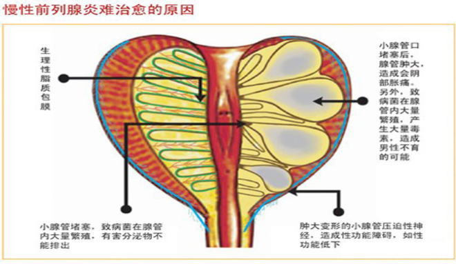 前列腺炎症状图集!前列腺炎怎么引起的