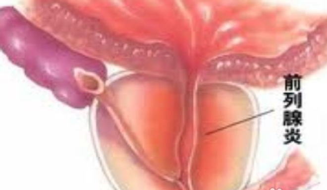 前列腺炎症状图集!前列腺炎怎么引起的