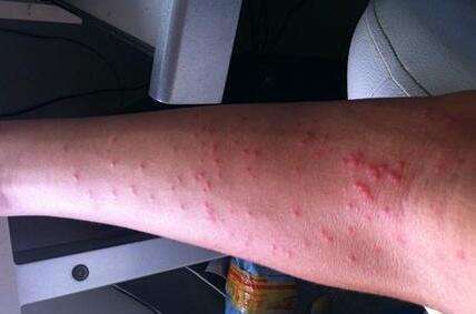 艾滋病初期症状!艾滋病初期症状有哪些?