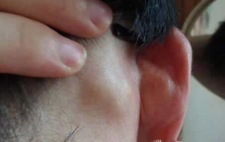 艾滋病的7个早期症状！最明显的还是皮肤上的一些病变