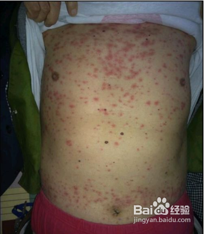 艾滋病的早期症状 4-8周内会有比较明显的症状