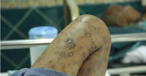 我这是艾滋病初期症状吗？我该怎么办啊 