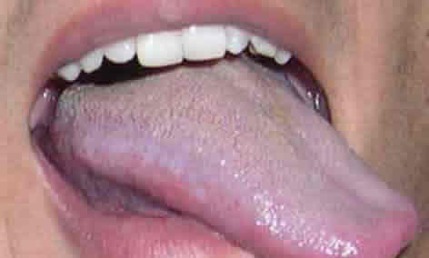 我这是艾滋病初期症状吗？我该怎么办啊 