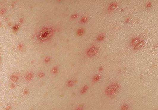 最常见的艾滋病初期症状 只有进行科学的艾滋病检测