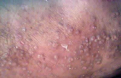 最常见的艾滋病初期症状 只有进行科学的艾滋病检测