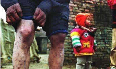 艾滋病真的没有一点早期症状吗？