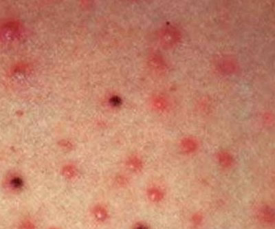 艾滋病初期皮肤症状介绍!我们一起来了解一下吧。