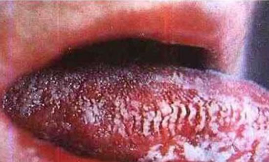 警惕 艾滋病的早期体表表现有哪些 