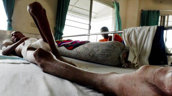 艾滋病早期皮疹斑疹都有哪些特点艾滋病的早期症状