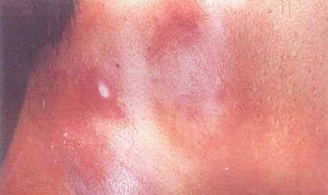 艾滋病初期症状你知多少 艾滋病初期症状你知多少