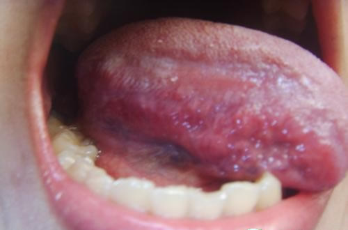 艾滋病初期症状你知多少 艾滋病初期症状你知多少