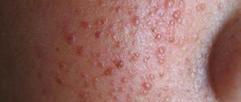 性病艾滋病早期有什么现象 　hiv感染初期症状有哪些？