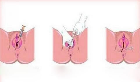 侧切伤口怎么护理？侧切会影响性生活吗