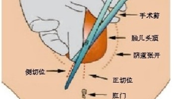 有经验的来说说,顺产侧切后下面会变松吗?