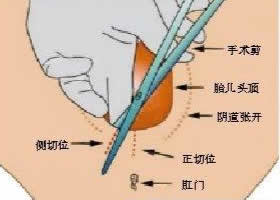 顺产侧切后缝合为什么不能使用麻醉？为什么剖腹产不能全麻？