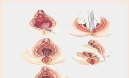 顺产后伤口护理,不能怠慢!伤口发生血肿等问题