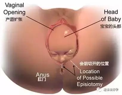 顺产侧切的真相,看完你愤怒了吗?侧切是人为干预顺产