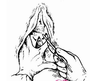 女人顺产侧切全过程（图片） 顺产侧切究竟是怎么一回事呢？