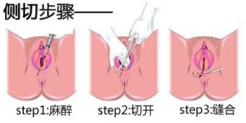 顺产侧切的真相，看完你愤怒了吗？